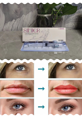 Sản phẩm làm đẹp Feamle chất lượng tốt Chất làm đầy da chống lão hóa y tế 2 Ml