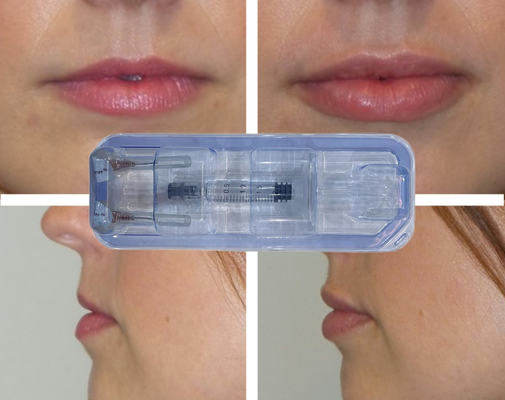 CE Tiêm Axit Hyaluronic Crosslinked Filler Lip Injection 24mg/ml