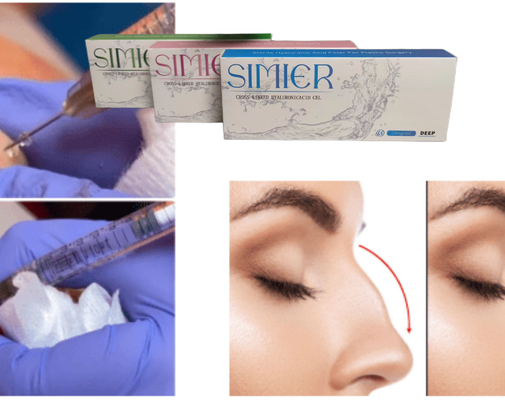 Xử lý tiêm gel hyaluronate natri 10ml trong suốt để lấp đầy các đường nở nụ cười