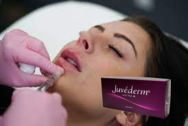 2 * 1ml Juvederm Ultra 3 Lip Filler Hyaluronic Acid Gel Fillers