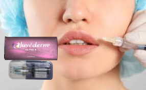 1ml / hộp Tiêm chất lấp môi, má, cằm