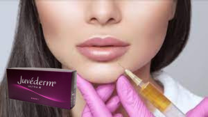 Juvederm Ultra 3 Hyaluronic Acid HA Dermal Filler 2ml Làm tăng môi