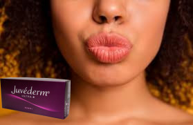 Juvederm Ultra 3 Hyaluronic Acid HA Dermal Filler 2ml Làm tăng môi