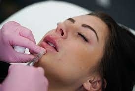 Hyaluronic acid tiêm Filler da Juvederm Ultra 3 1mlx2